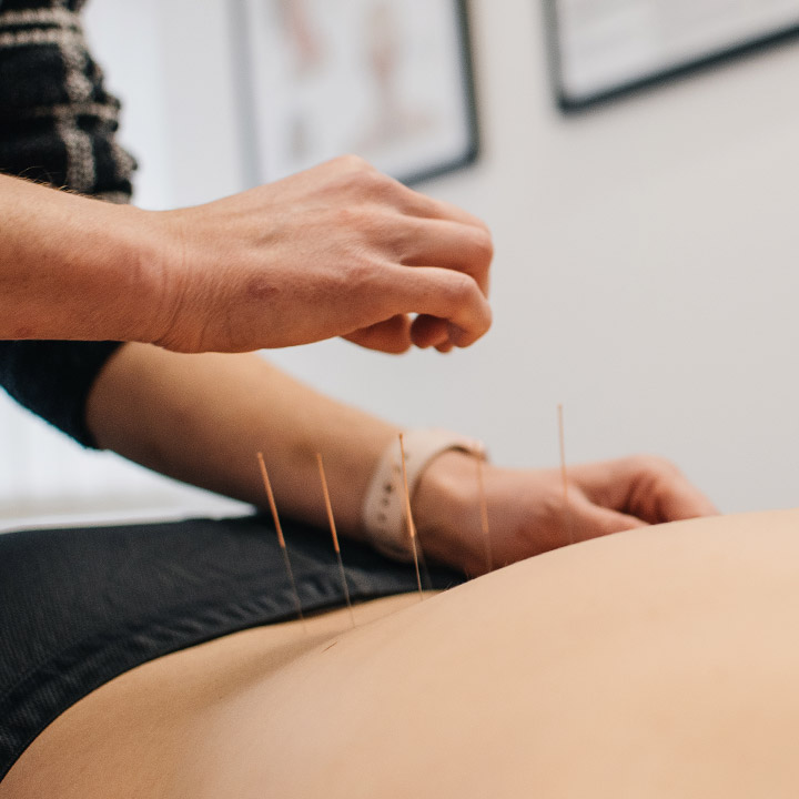 Acupuncture services in Dunmow