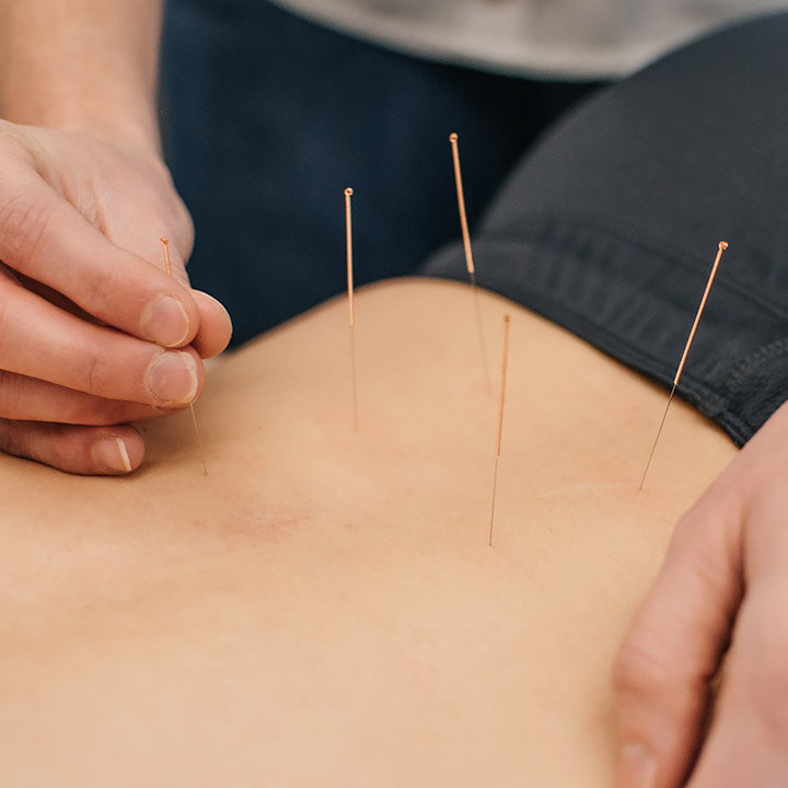 Acupuncture treatment in Dunmow